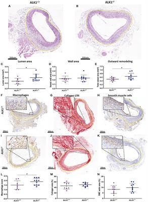 Interfering in the ALK1 Pathway Results in Macrophage-Driven Outward Remodeling of Murine Vein Grafts